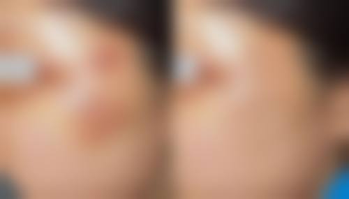 整容可以祛疤痕吗