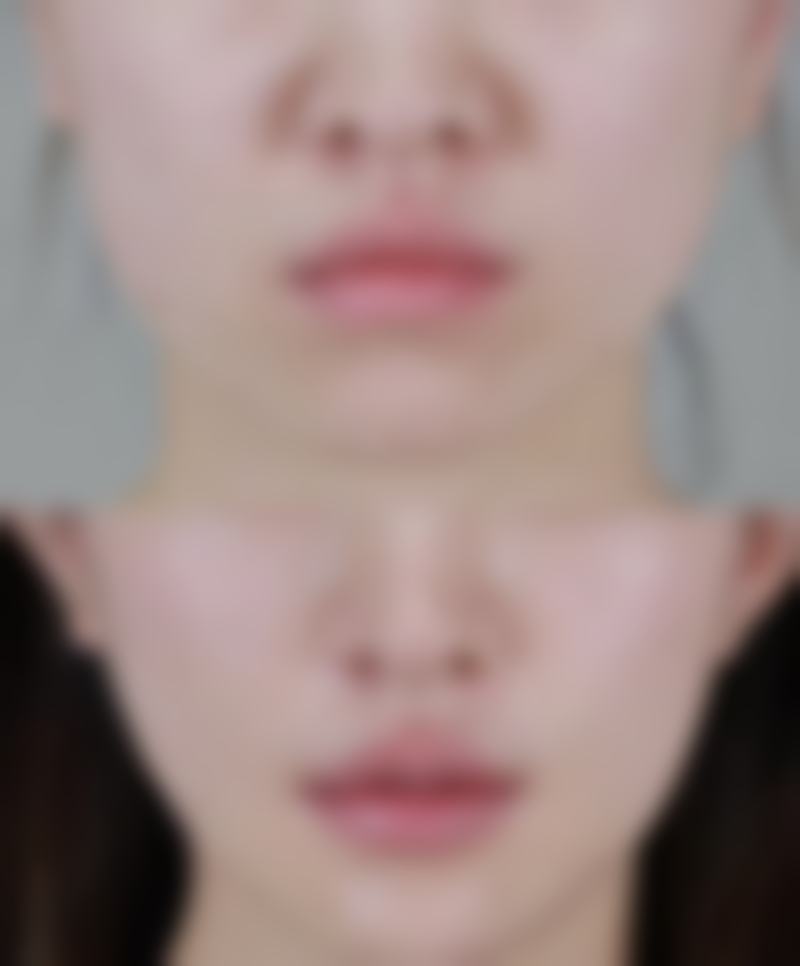 打瘦脸针后的注意事项
