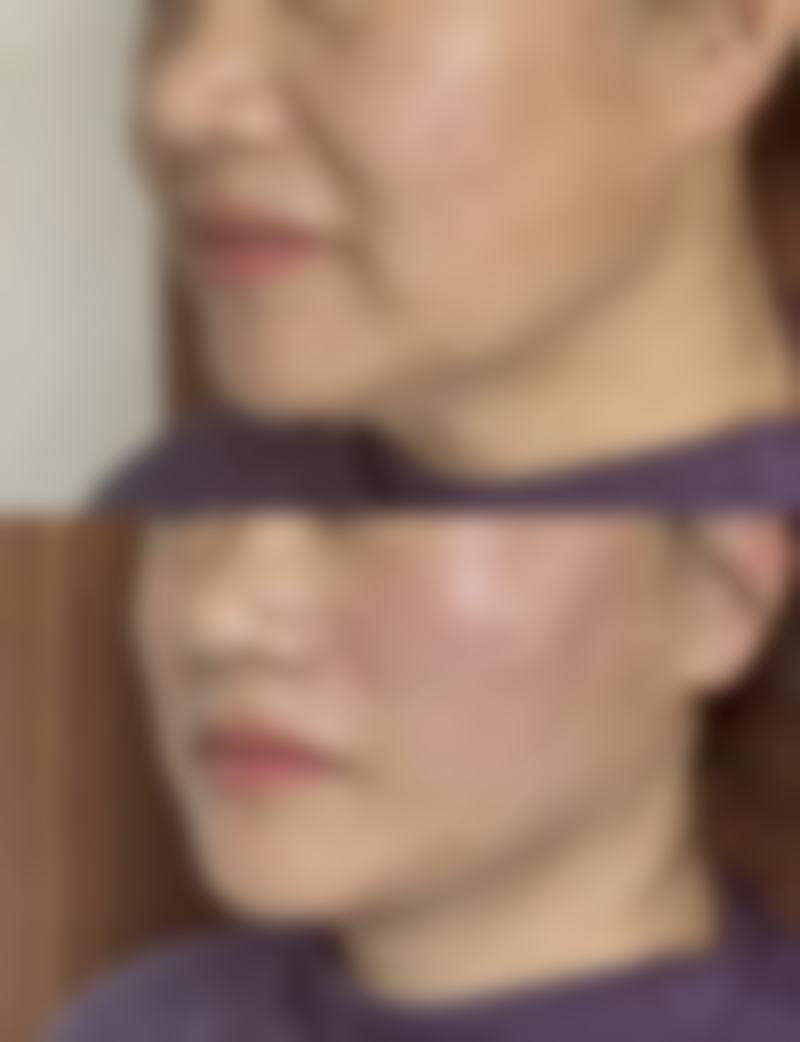 打瘦脸针有用吗？会不会有副作用？