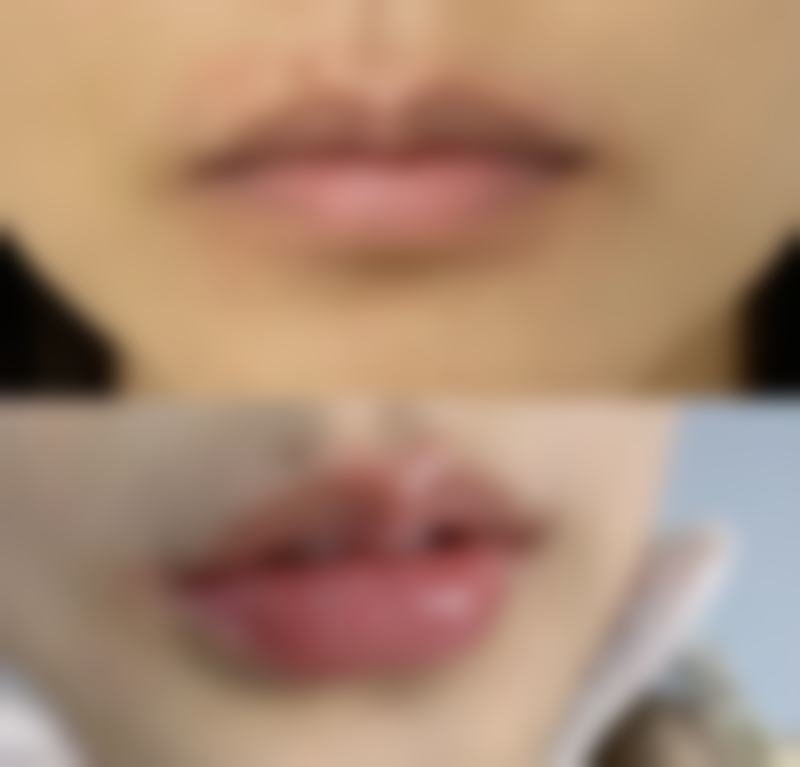 怀孕后可以打瘦脸针吗？权威解析孕期打瘦脸针的潜在风险与安全底线，为准妈妈美丽健康保驾护航！ 