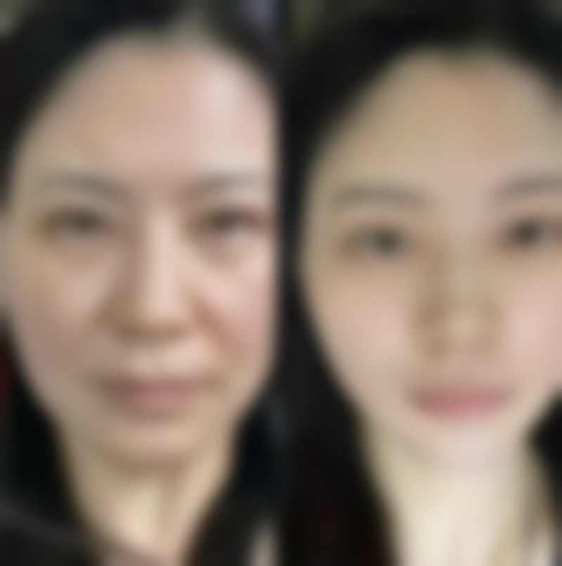 打瘦脸针需要注意什么