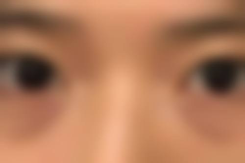 种植发际线有哪些技术?