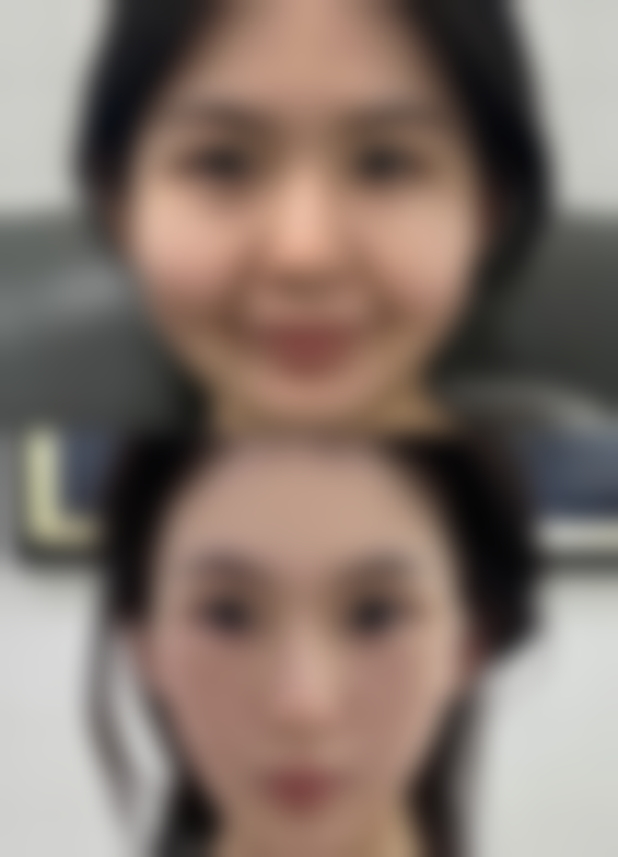 下巴后缩的自我改善方法与锻炼