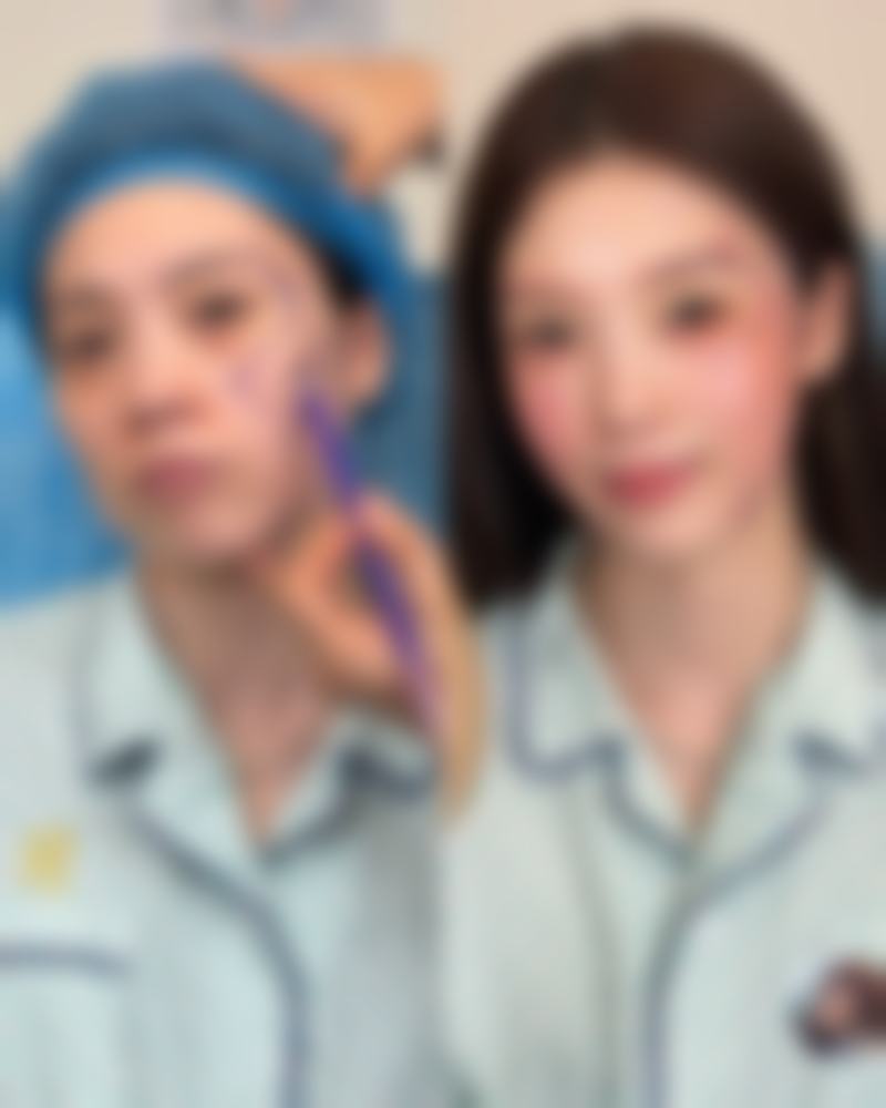 嘴唇整形后怎么护理