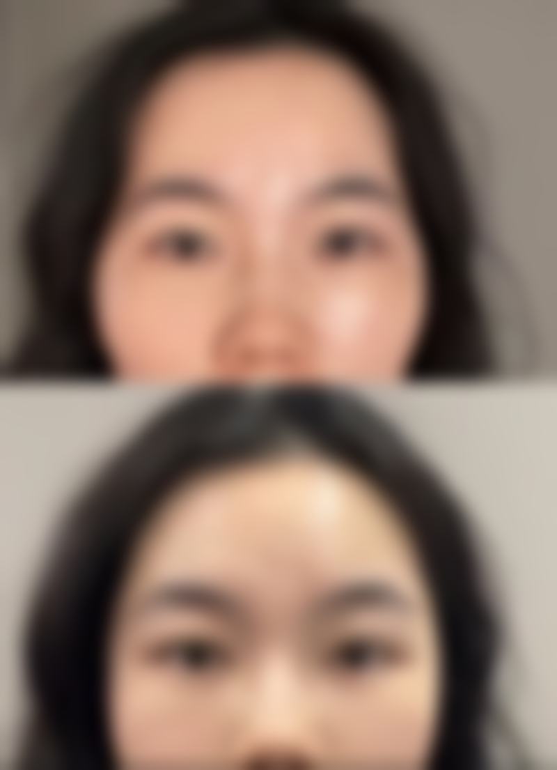 扎瘦脸针多久能看到成效