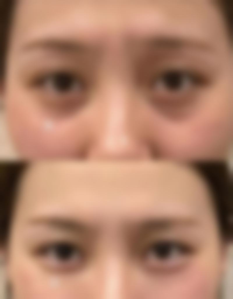 瘦脸针的包装规格