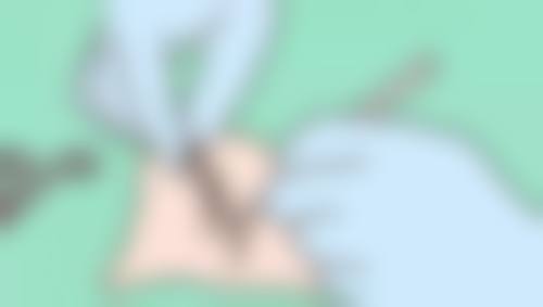 毛发种植多少小时能慢慢固定