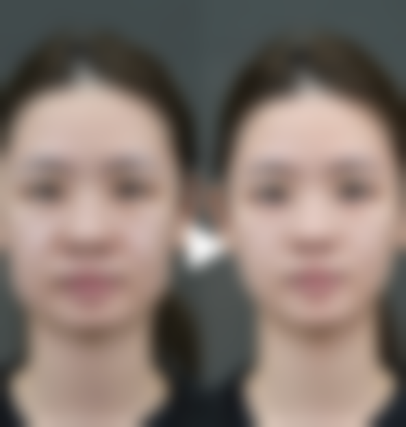 孕期能打美白针吗？孕期可以打美白针吗？