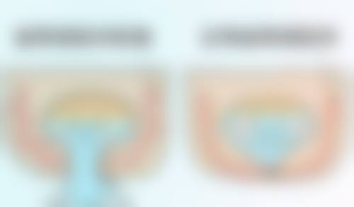 打了瘦脸针没有感觉会影响成效吗