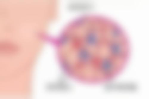 超声炮对眼袋有成效吗