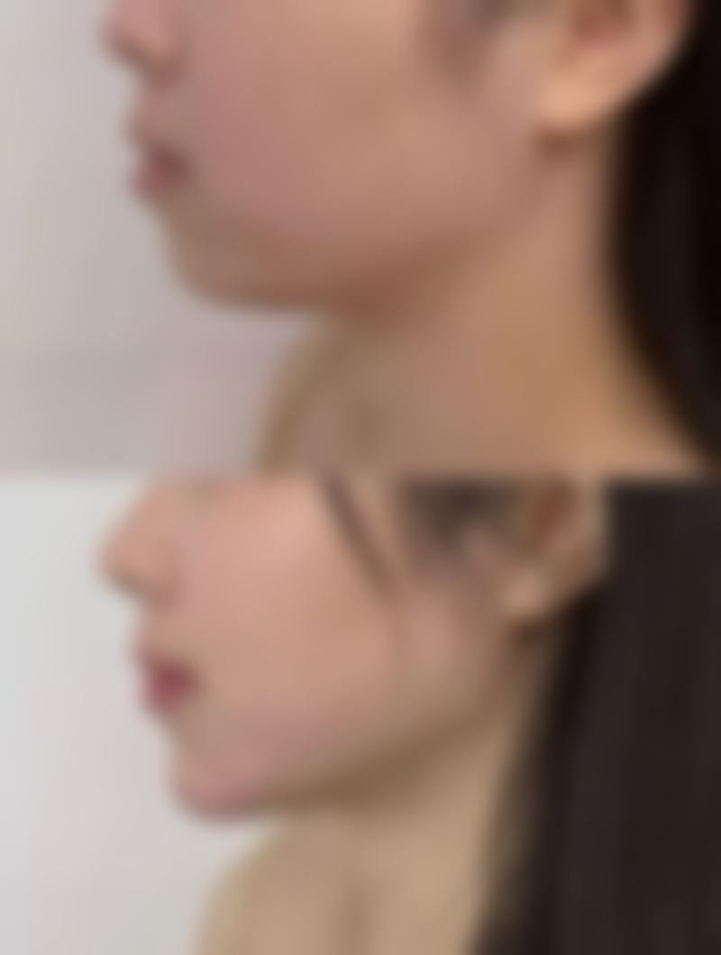 超声炮和除皱针的顺序