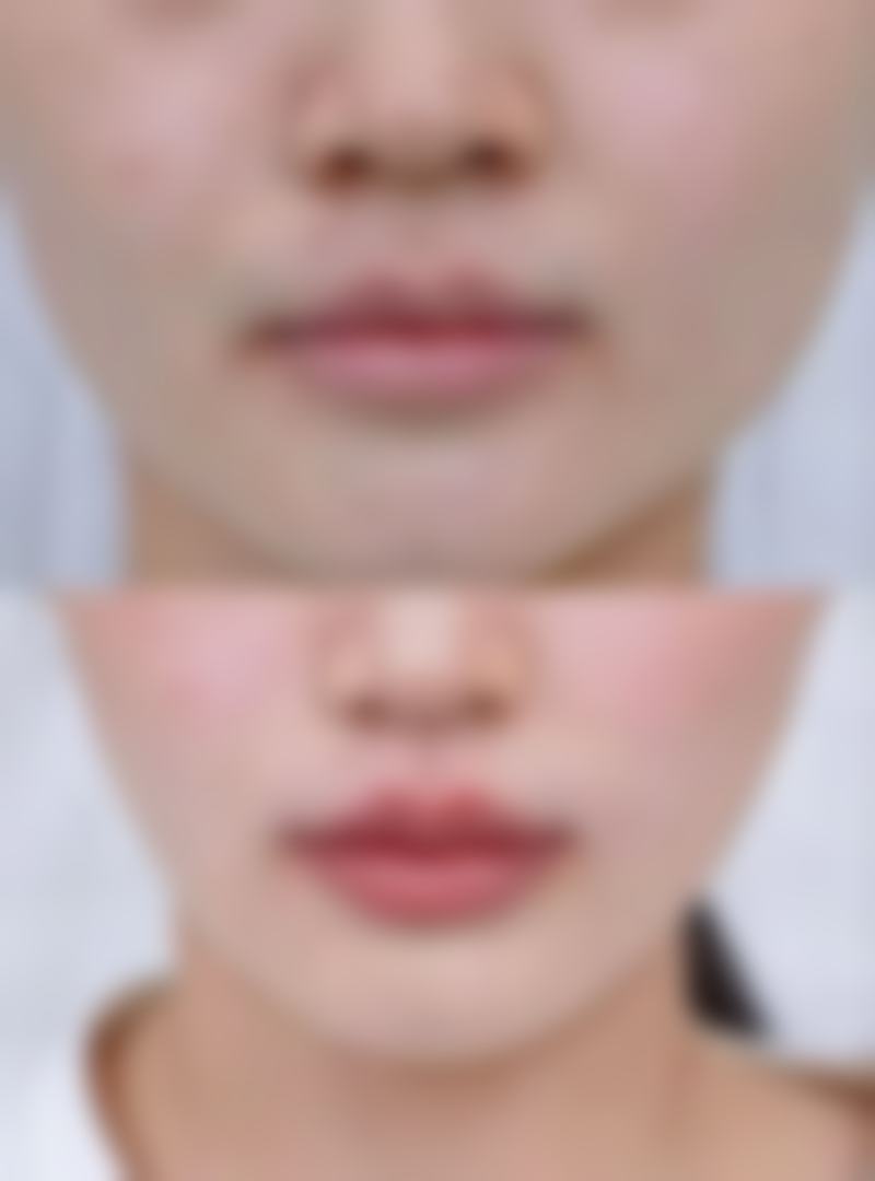 超声炮有成效吗