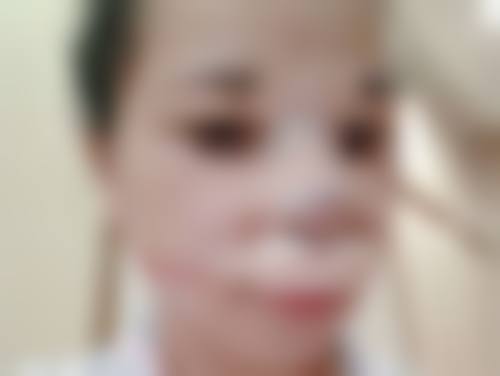 不同人打完瘦脸针的反应