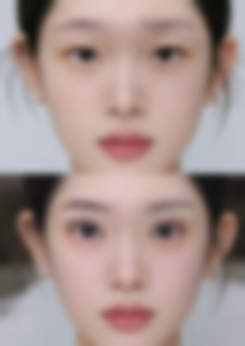 手术缩阴