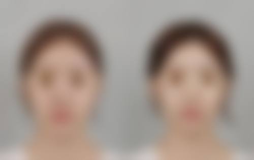 瘦脸针和提升针能一起打吗？权威解答来了！二者联合注射优势多，助你快速拥有紧致小V脸！ 