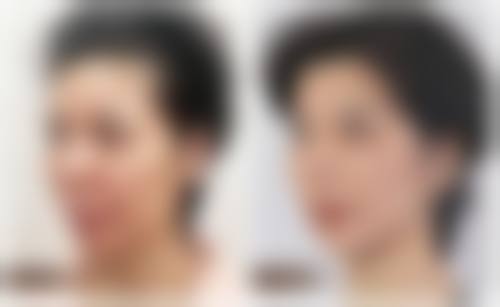 毛发种植会生长吗