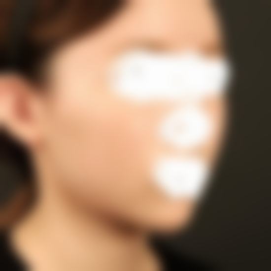 韩国TS整形医院李相均全脸综合整形实例成效值不值？