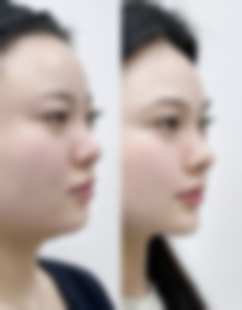 国产瘦脸针敢打吗