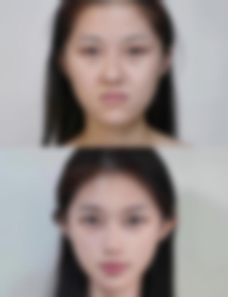 打除皱针多少钱一支