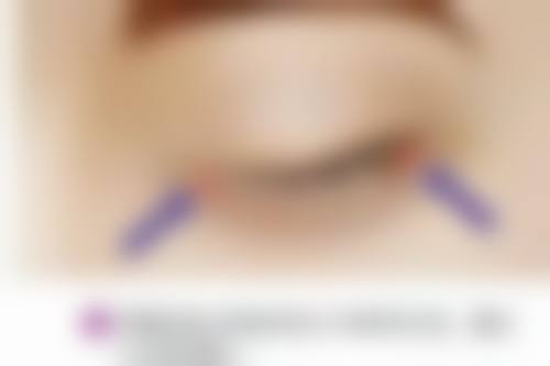 打理想白针多久可以洗脸