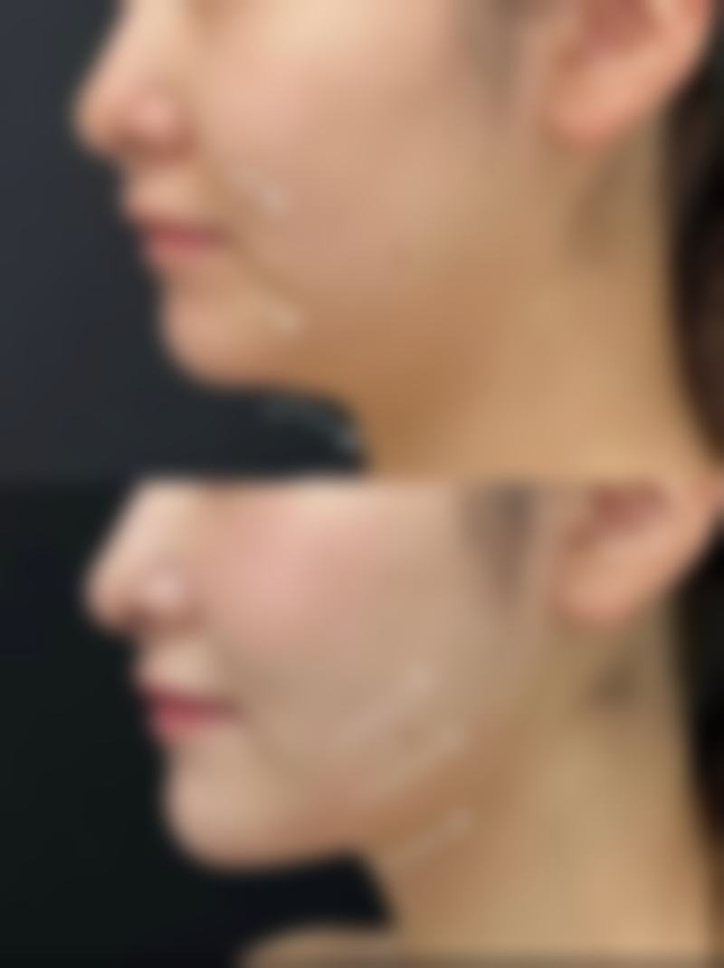 打瘦肩针有什么危害