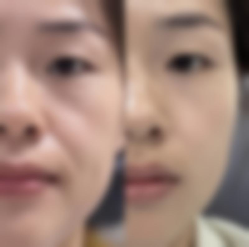 阴式子宫切除+阴道前后壁修补术与产后修复