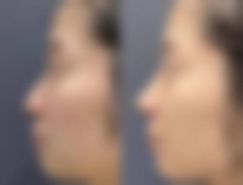 瘦脸针打一次维持多久