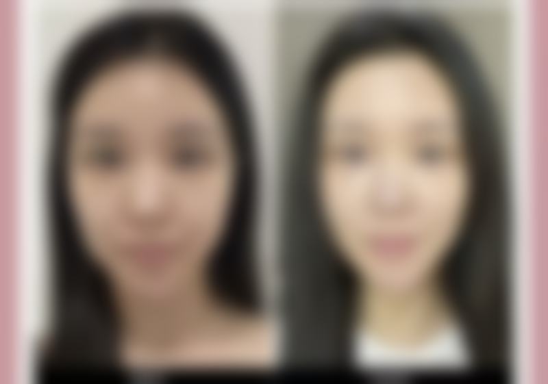 瘦脸针和下颌缘提升一起打
