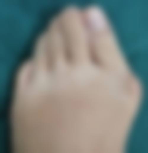 打完瘦脸针多久可以趴着睡