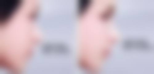 韩国瘦脸的整体情况
