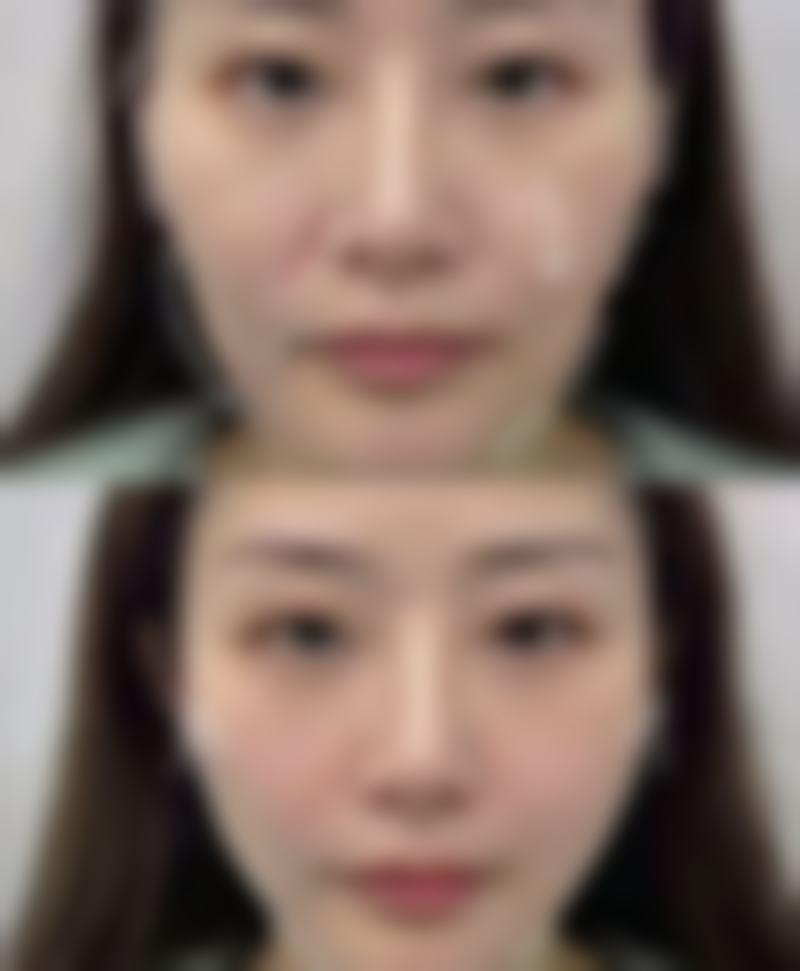 打瘦脸针能管多久