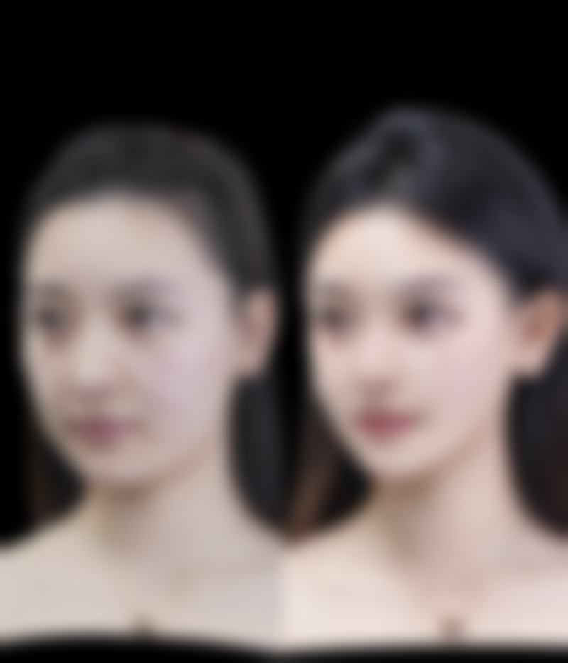打完瘦脸针多久可以平躺