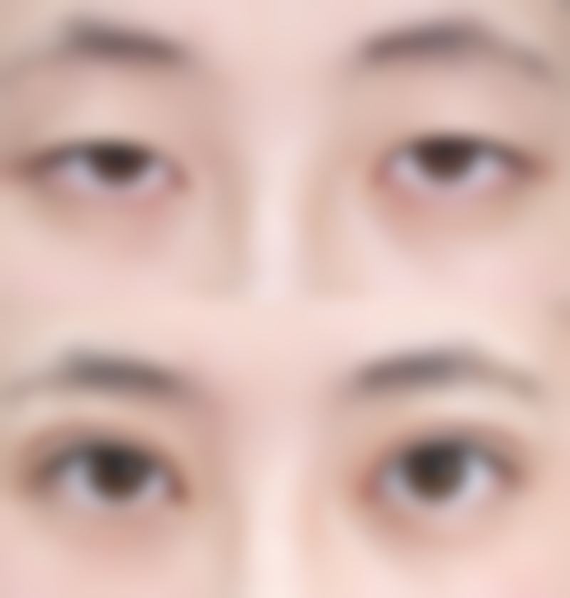 瘦脸针成效更明显的时间