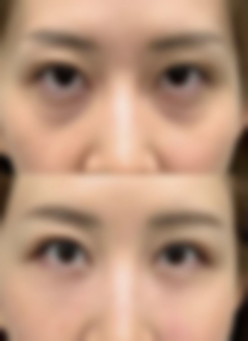 美白针全身美白能保持多久？