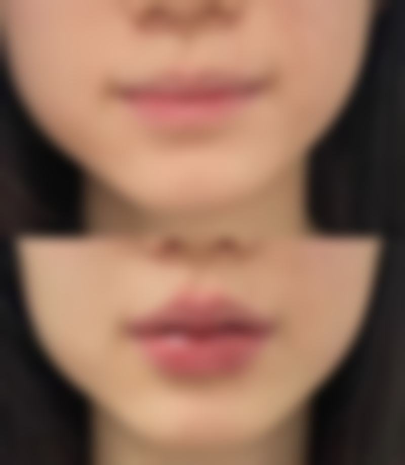 美白针原本不是用来美白？