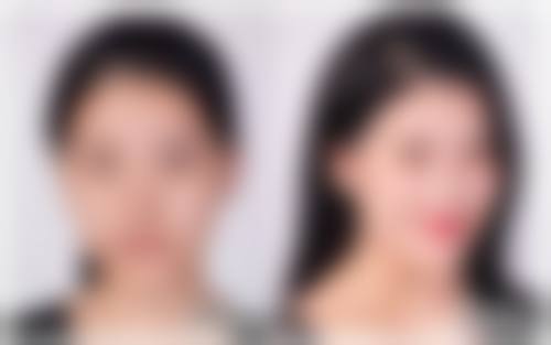瘦脸针打完多久见效
