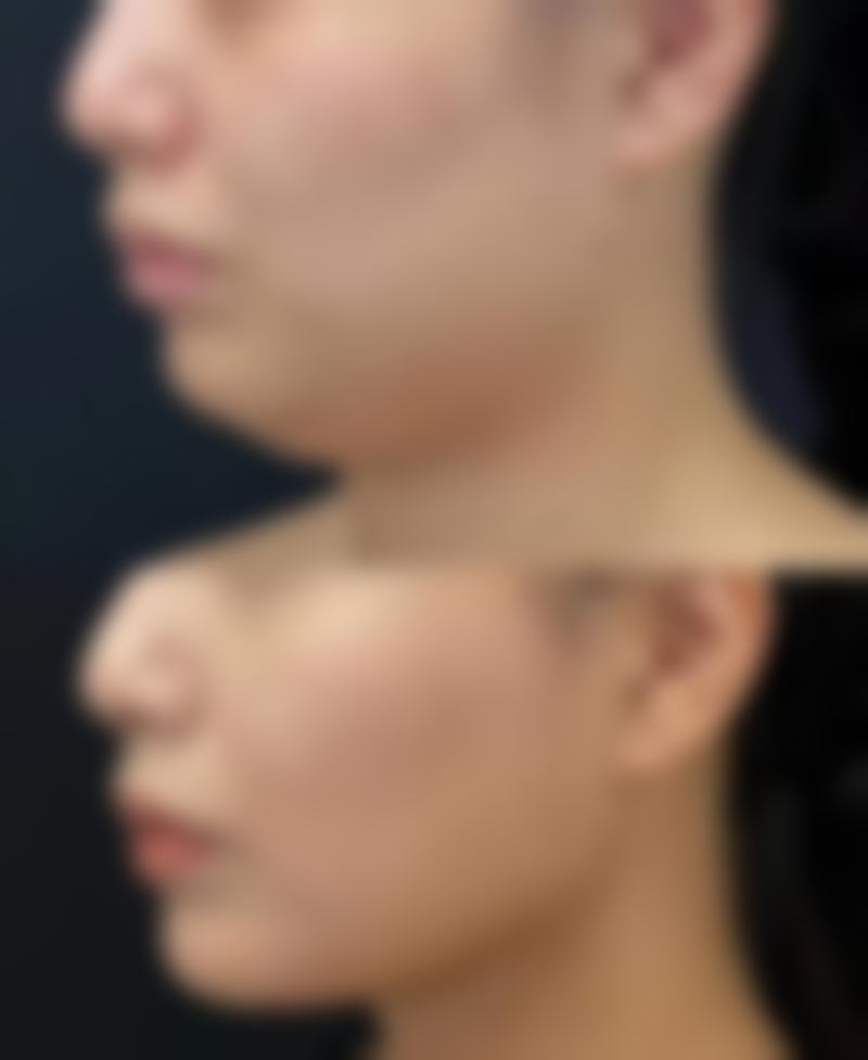 打瘦脸针有后遗症吗