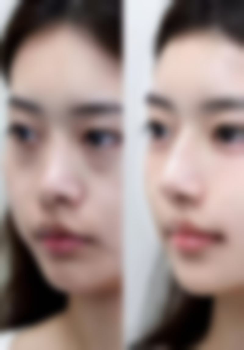 韩国dr.skinny整形医院的特色项目众多,涵盖了身体塑形、吸脂瘦腹部、腹壁成型、激光溶脂、吸脂瘦腰等身体塑形相关项目,还有牙贴面、垫鼻尖、膨体隆鼻、手术缩鼻头、祛斑等项目,无论是想要改善身材还是面部五官、皮肤问题,在这里都能找到合适的解决方案。