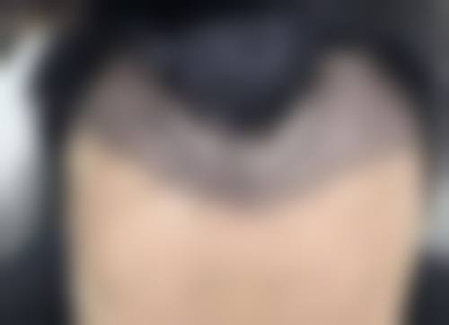 不同人群的修复特点