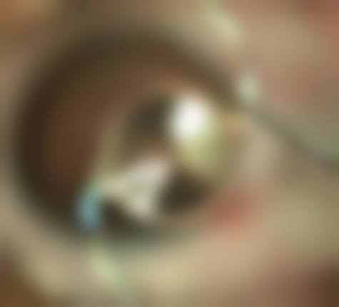 结尾预约号召河北北方学院附属第二医院眼科李亚坤