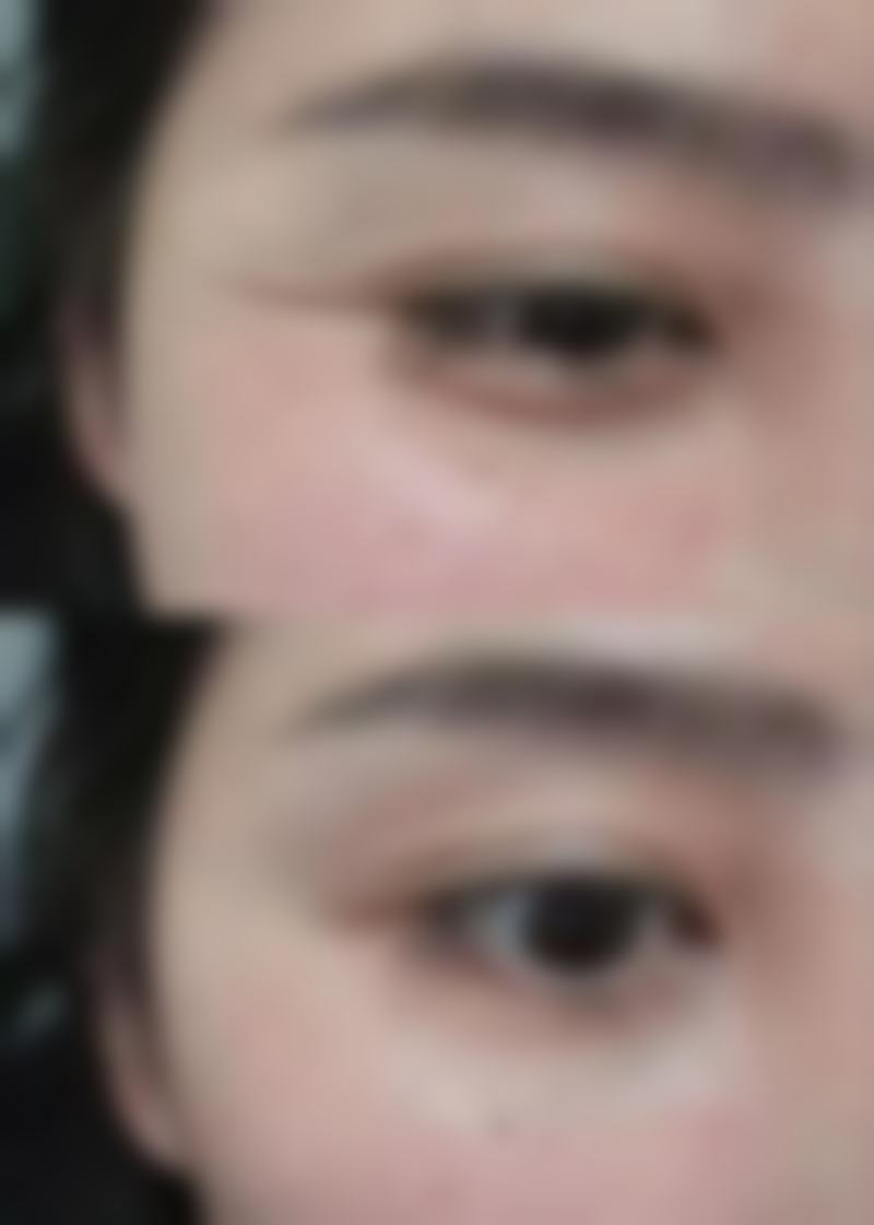 打了瘦脸针一年后突然出来小硬块是怎么回事