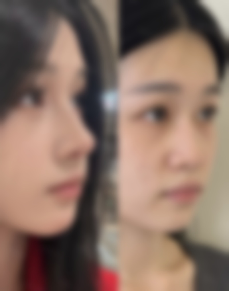 美白针可以维持多久?不同个体的维持差异