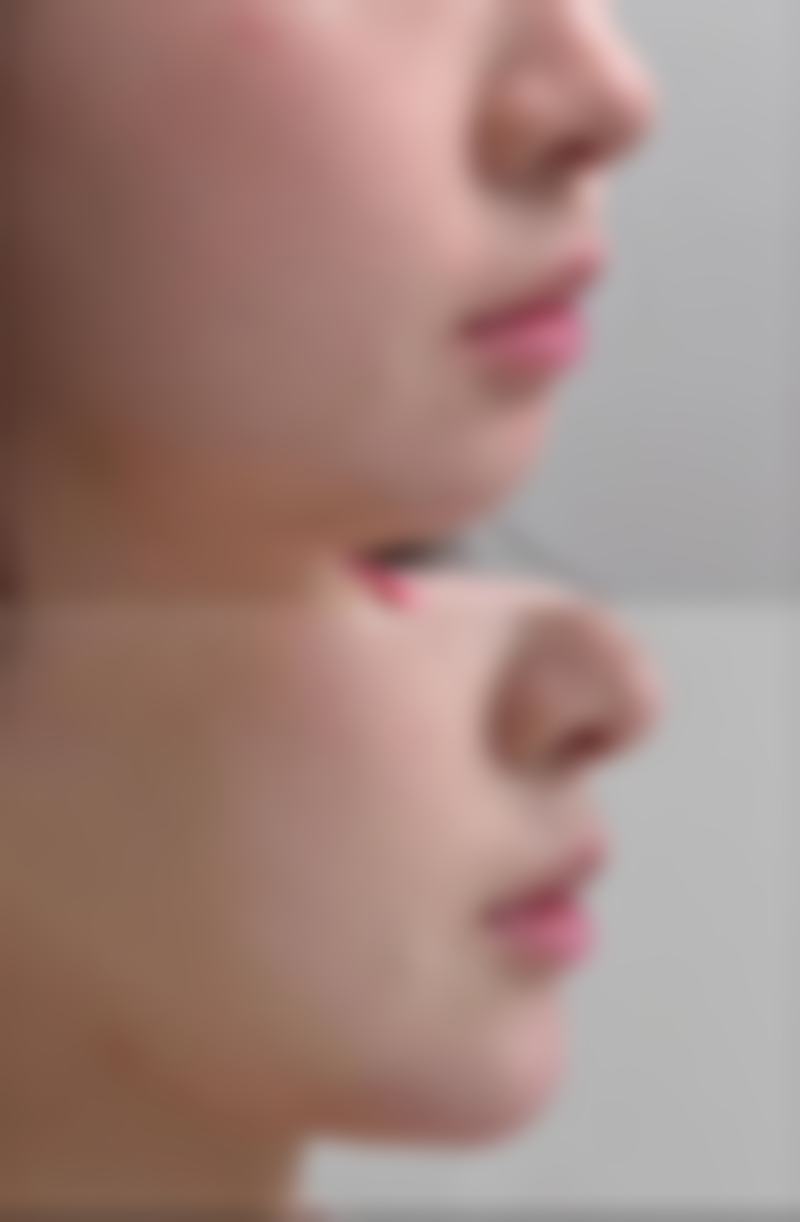 国产瘦脸针有成效吗?适合哪些人群注射