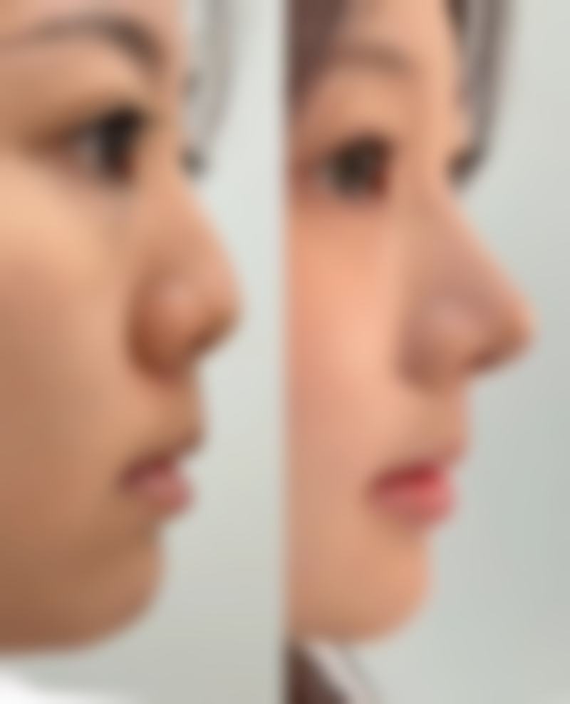 除皱针多久打一次更好有无副作用,合理的注射间隔参考