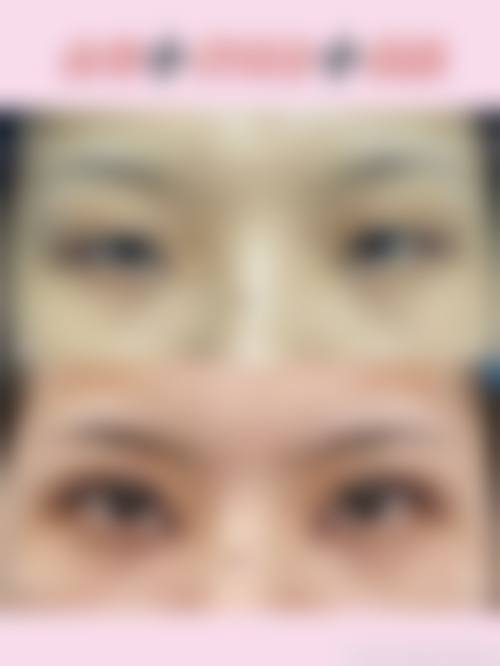 临床实例分享南京怡柏芬医疗美容诊所