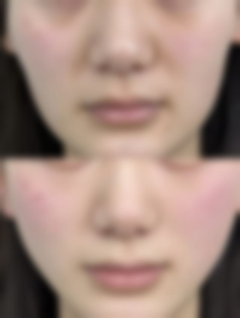 韩国白毒瘦脸针安心吗是真的吗?哪些人适合注射?