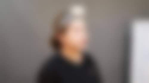 临床实例分享:西安熙朵医疗美容门诊部(熙朵植发连锁西安分院)闫莹莹的真实见证