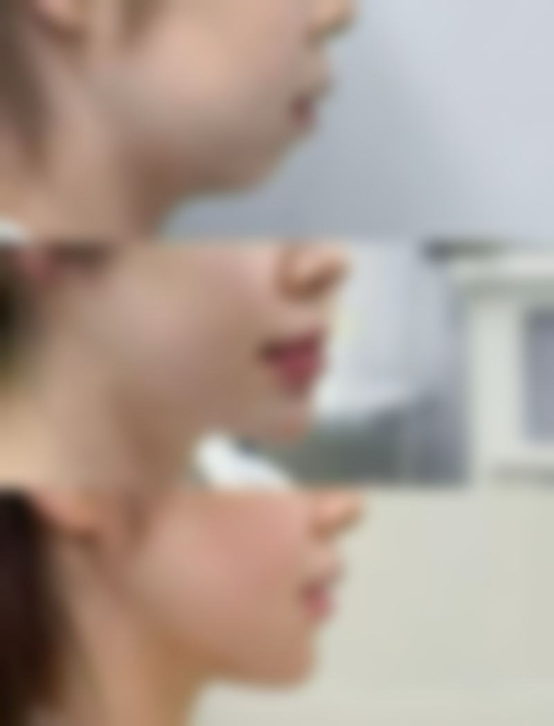 哪些因素会影响瘦脸针的实际成效?