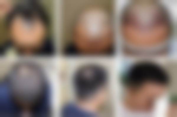 合肥曙光植发医美品牌简介,做微针加密植发2500单位21500元起性价比拉满