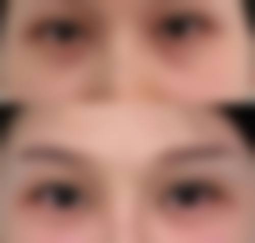 临床实例分享长春德美（谭硕士）医疗整形美容门诊部